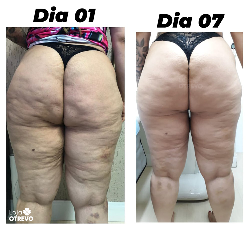 DrenaSkin® 3 em 1  - Massageador Redutor de Celulite e Gorduras Localizadas