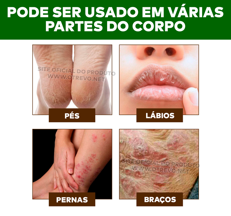 Cera Removedora de Calos e Rachaduras - ®Foot Gold