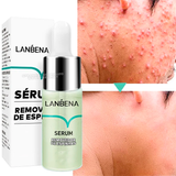 Sérum Removedor de Acne e Poros Dilatados - AcneLanbéna®