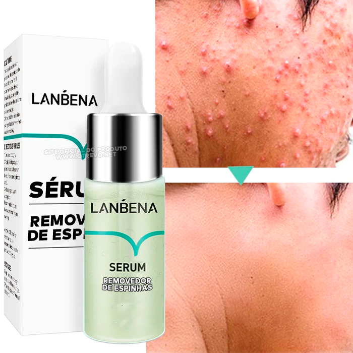 Sérum Removedor de Acne e Poros Dilatados - AcneLanbéna®