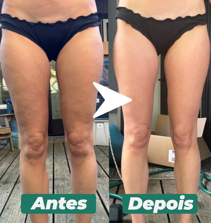 DrenaSkin® 3 em 1  - Massageador Redutor de Celulite e Gorduras Localizadas