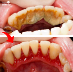 JatoClean®  - Irrigador Oral para Limpeza Bucal