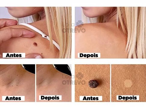 PenWart® - Caneta Removedora de Verrugas e Sinais da Pele (EFEITO IMEDIATO)