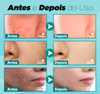 Creme Clareador de Manchas Escuras à Base de Leite - Milk Whitening® (Clareamento 100% Comprovado)