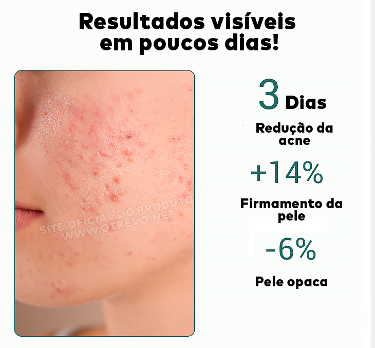 Sérum Removedor de Acne e Poros Dilatados - AcneLanbéna®