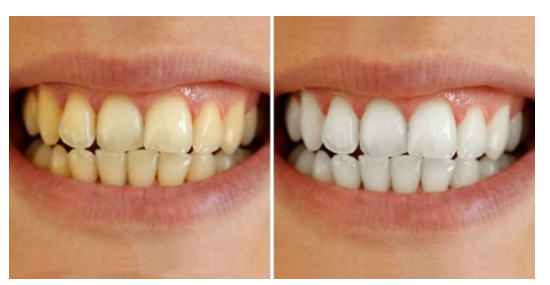 Super Fita Clareadora Dental A Base de Bambu e Carvão Vegetal - WhiteTeeth®(DENTES BRANCOS EM 30 MINUTOS)