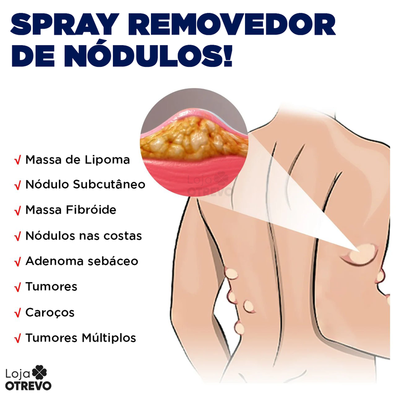 Spray Removedor de Nódulos - Lipomax®