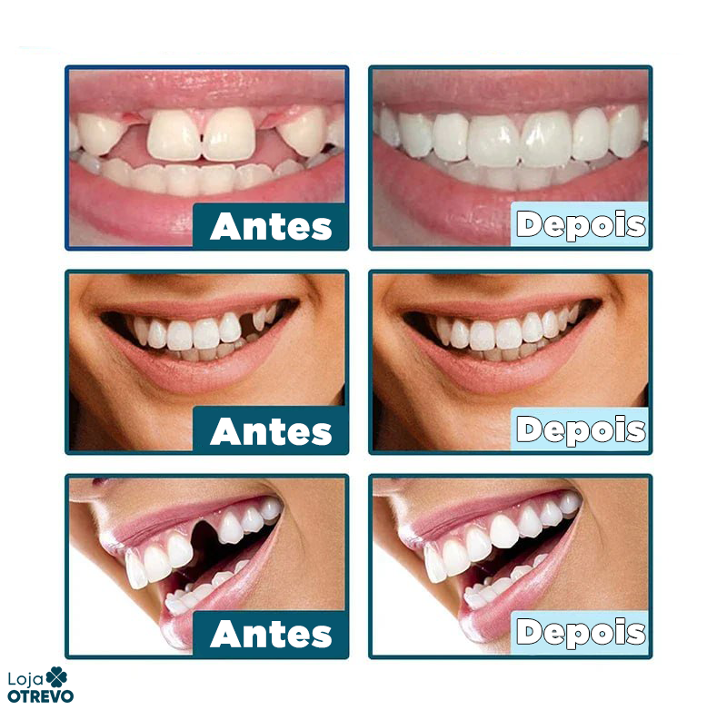  Facetas Dentárias Naturais Removíveis