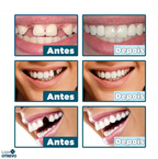  Facetas Dentárias Naturais Removíveis
