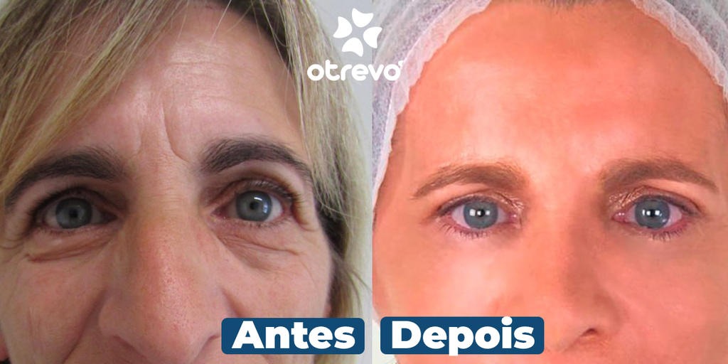 OpenEyes - Creme Reparador Rápido de Olhos (Elimina Rugas, Bolsas e Olheiras)