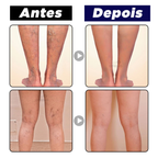 Creme Removedor Rápido de Varizes - Varimax® (ELIMINAÇÃO TOTAL DAS VARIZES)
