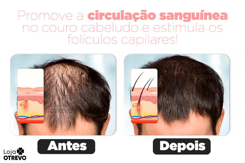 Escova Terapêutica Capilar 4 em 1 ( Fototerapia, Crescimento Capilar e Antiqueda) - ScalpHair®