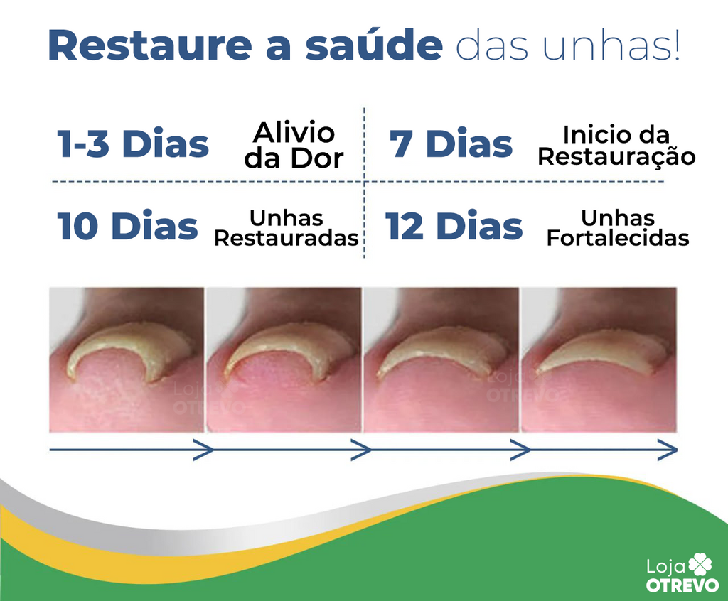Adesivos Corretores de Unha - PatchNail® (REPARAÇÃO EM 7 DIAS)