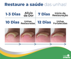 Adesivos Corretores de Unha - PatchNail® (REPARAÇÃO EM 7 DIAS)