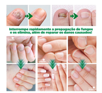 OilNail® - Sérum Reparador Rápido de Unhas (REPARAÇÃO EM 7 DIAS)