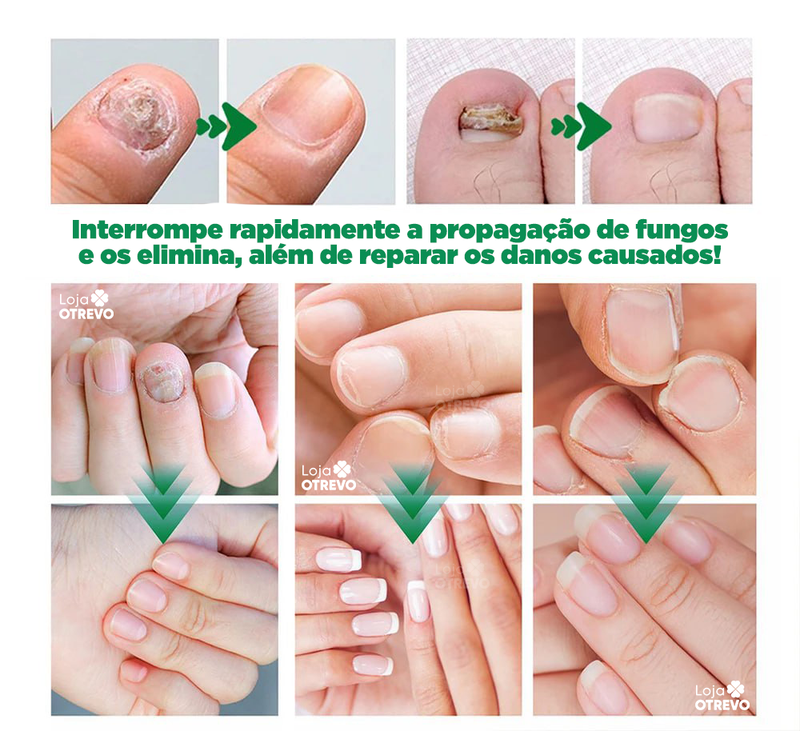 OilNail® - Sérum Reparador Rápido de Unhas (REPARAÇÃO EM 7 DIAS)