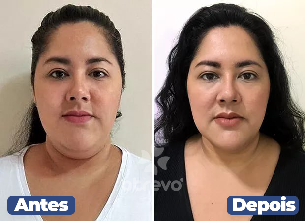 UpFace -  Esticador de Rosto e Redutor de Papada (EFEITO LIFITING INSTANTÂNEO)