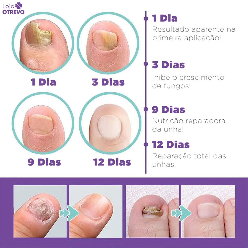 Spray Reparador de Unhas 3 em 1 (Reparador, Restaurador e Fortalecedor de Unhas) MedNail®