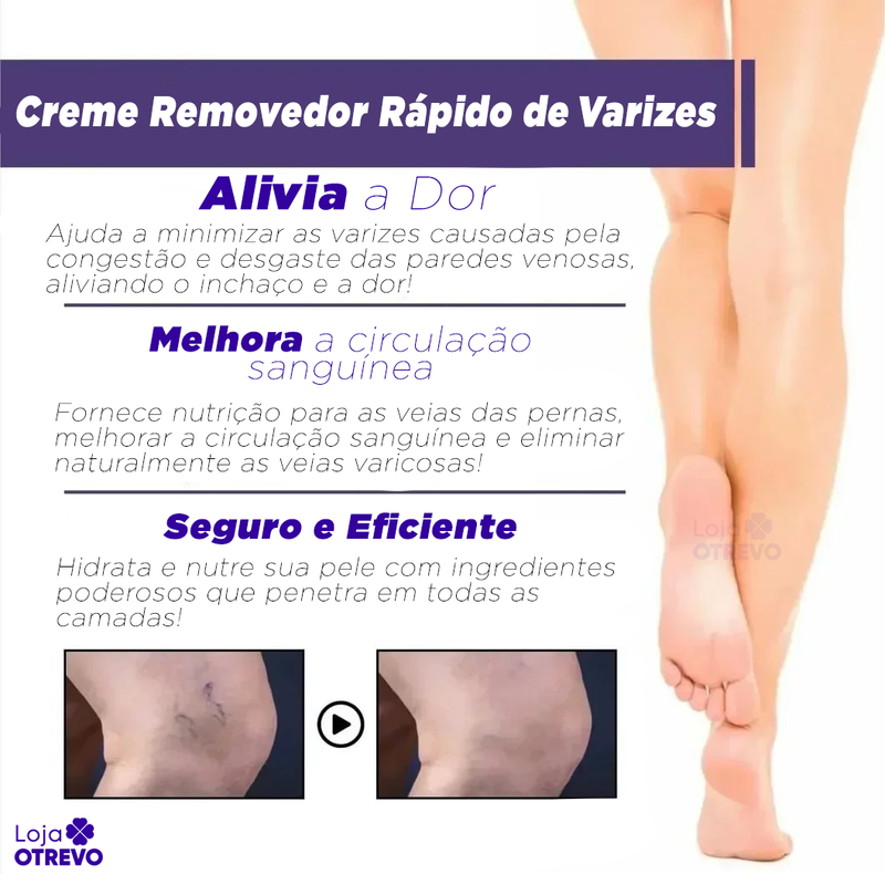 Creme Removedor Rápido de Varizes - Varimax® (ELIMINAÇÃO TOTAL DAS VARIZES)