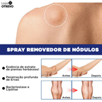 Spray Removedor de Nódulos - Lipomax®