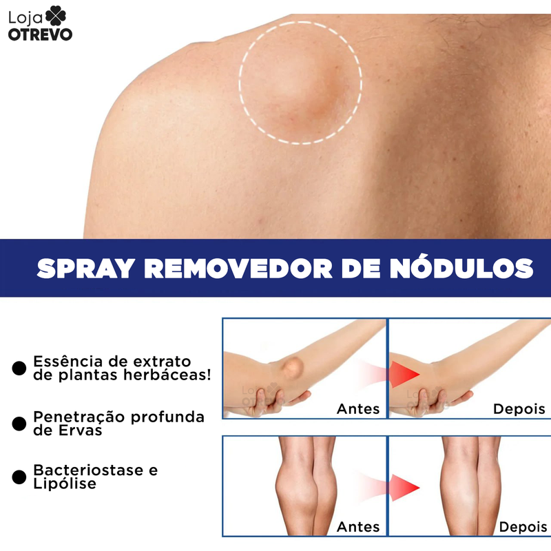 Spray Removedor de Nódulos - Lipomax®