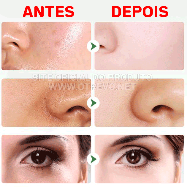 Mascara de Chá Verde Removedora de Cravos, Acne e Poros - MaskGreen® (ULTIMAS UNIDADES EM PROMOÇÃO)
