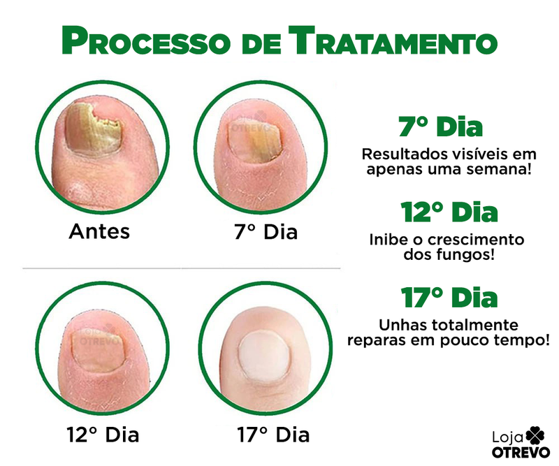 OilNail® - Sérum Reparador Rápido de Unhas (REPARAÇÃO EM 7 DIAS)