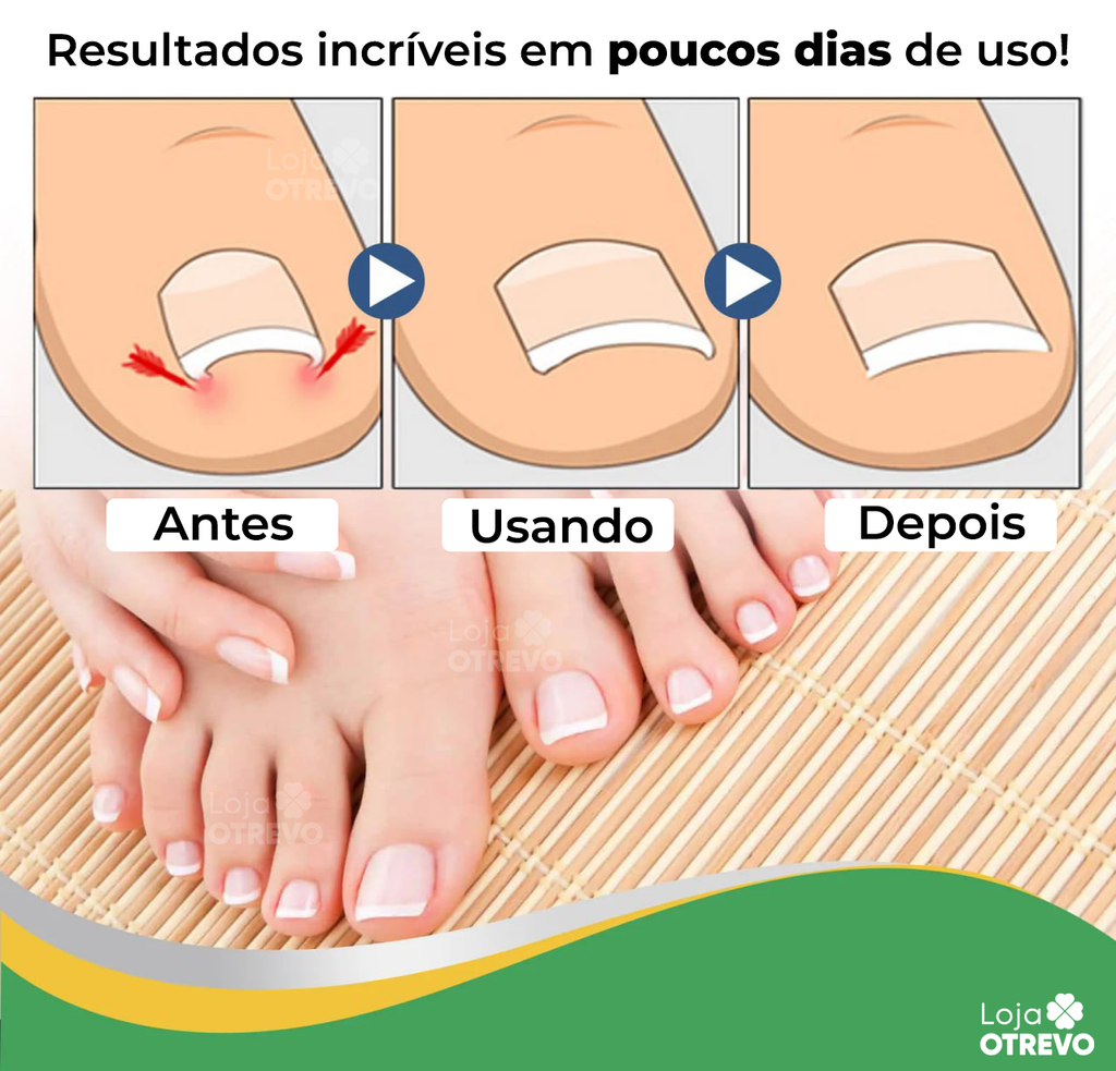 Adesivos Corretores de Unha - PatchNail® (REPARAÇÃO EM 7 DIAS)