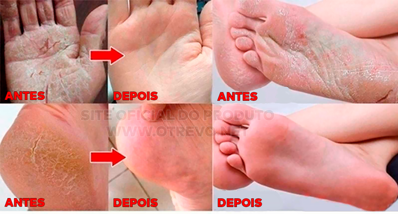 Cera Removedora de Calos e Rachaduras - ®Foot Gold