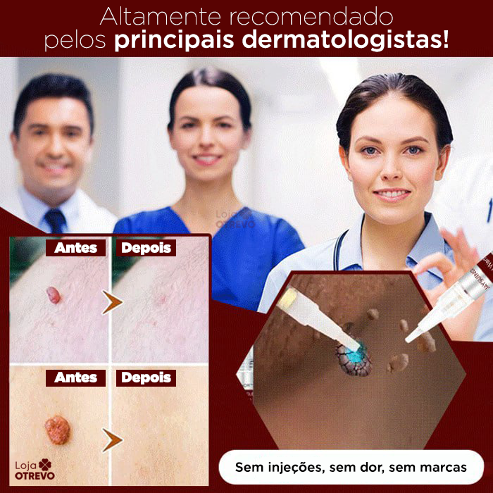 PenWart® - Caneta Removedora de Verrugas e Sinais da Pele (EFEITO IMEDIATO)