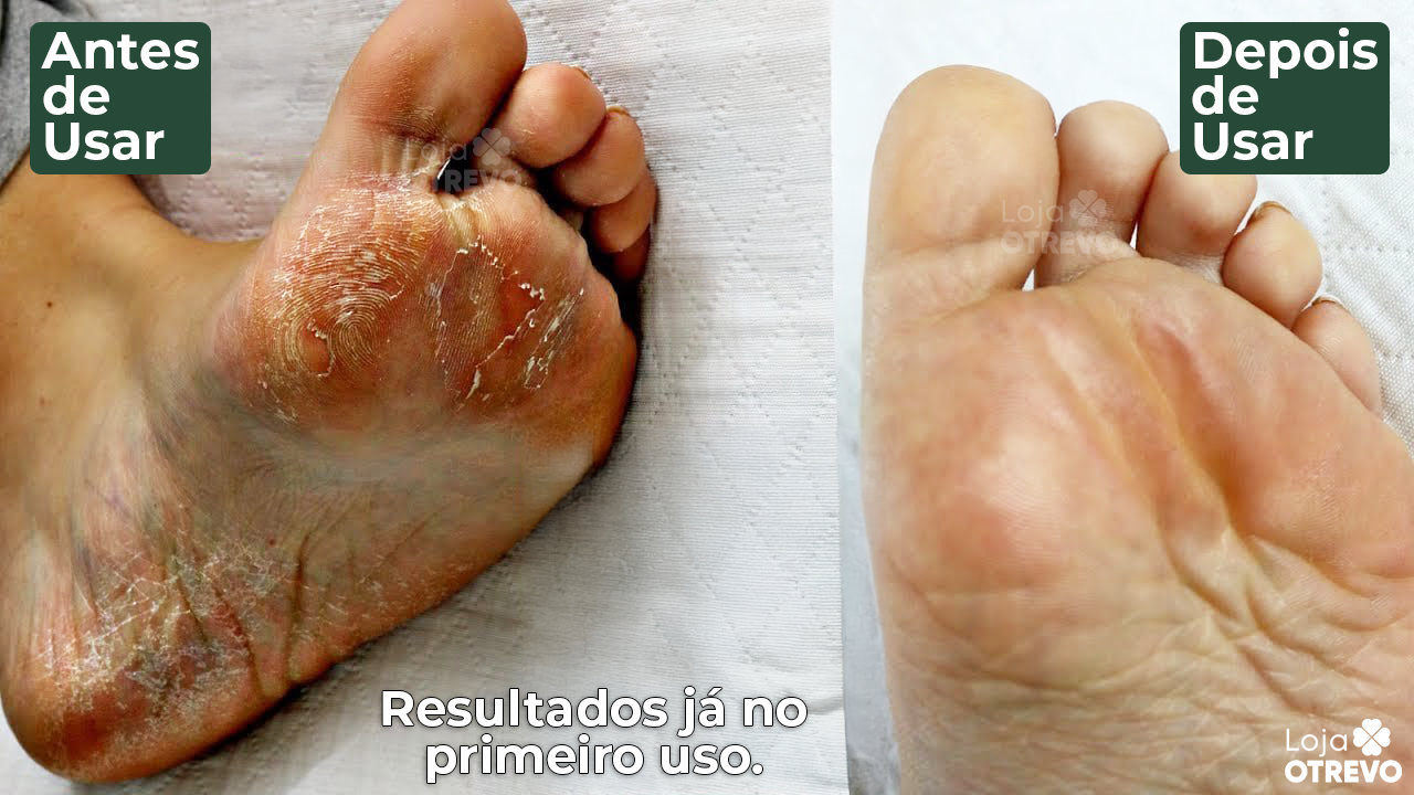 DermaShield - Spray Restaurador Rápido de Pés