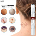 PenWart® - Caneta Removedora de Verrugas e Sinais da Pele (EFEITO IMEDIATO)
