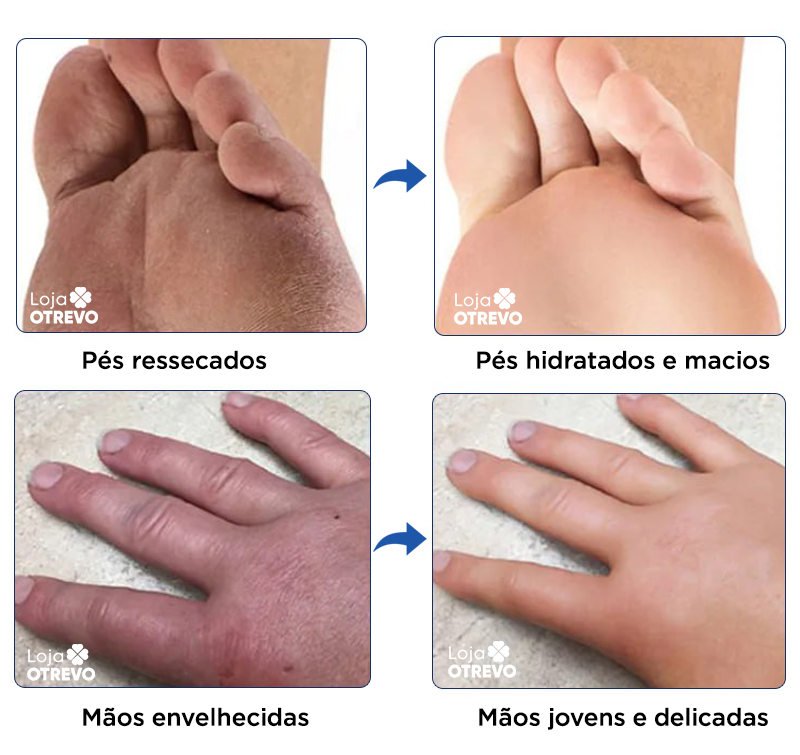 Bastão Removedor de Calos e Rachaduras (SUPER HIDRATANTE) BabyFeet®