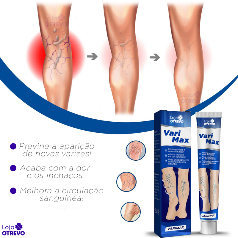 Creme Removedor Rápido de Varizes - Varimax® (ELIMINAÇÃO TOTAL DAS VARIZES)