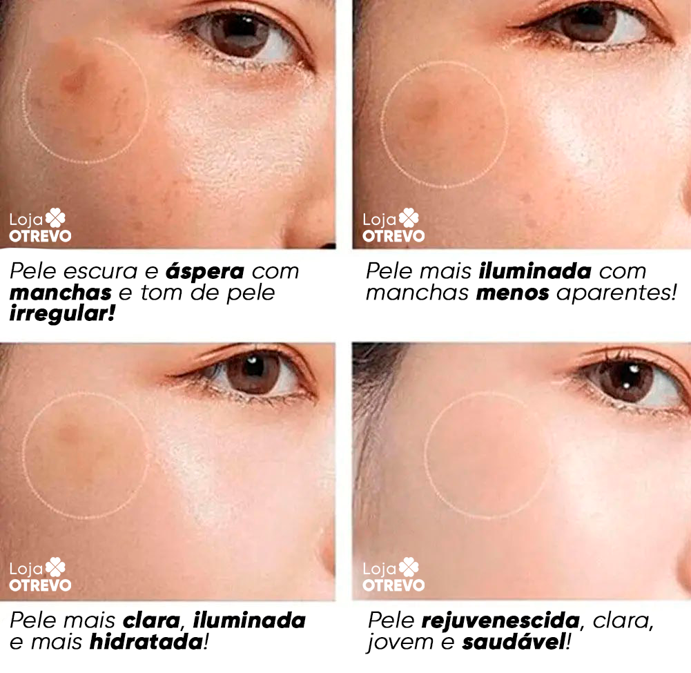 Creme Clareador de Manchas Escuras à Base de Leite - Milk Whitening® (Clareamento 100% Comprovado)