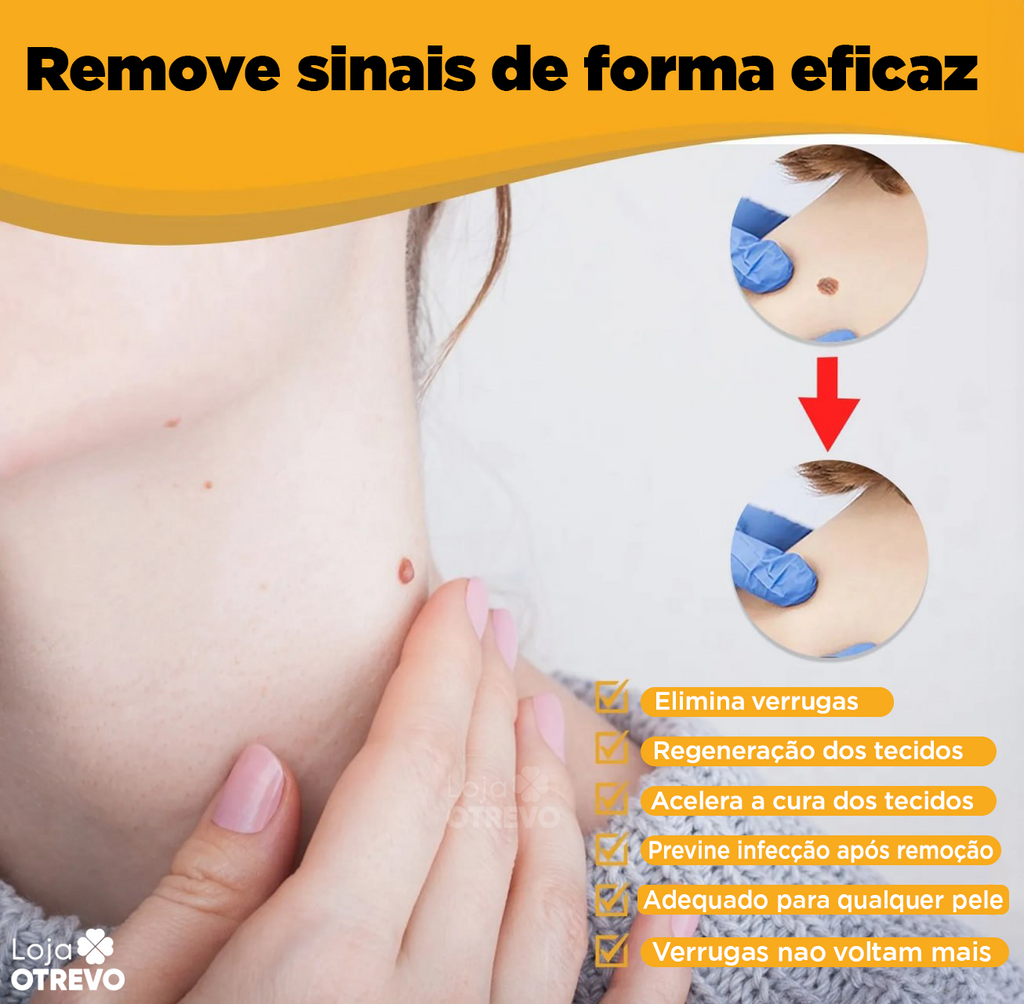 BeeTag - Spray Removedor Instantâneo de Verrugas e Sinais da Pele (EFEITO IMEDIATO)