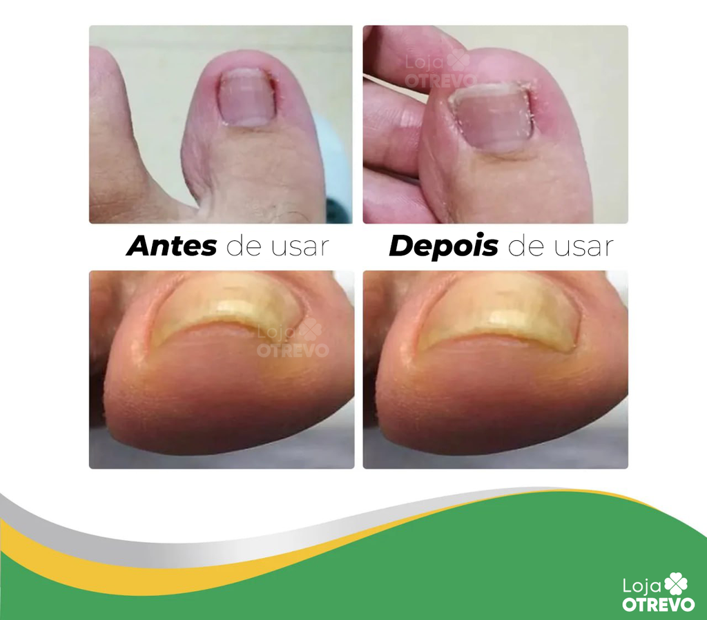 Adesivos Corretores de Unha - PatchNail® (REPARAÇÃO EM 7 DIAS)