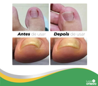 Adesivos Corretores de Unha - PatchNail® (REPARAÇÃO EM 7 DIAS)