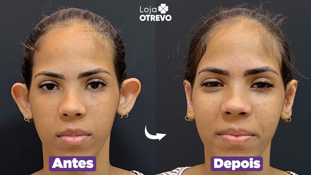 Adesivos Reutilizaveis Corretores de Orelha - EarIt®