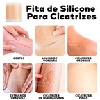 Fita de Silicone Gel Clareador Para Cicatriz (3 METROS)  - ®SilconeScar