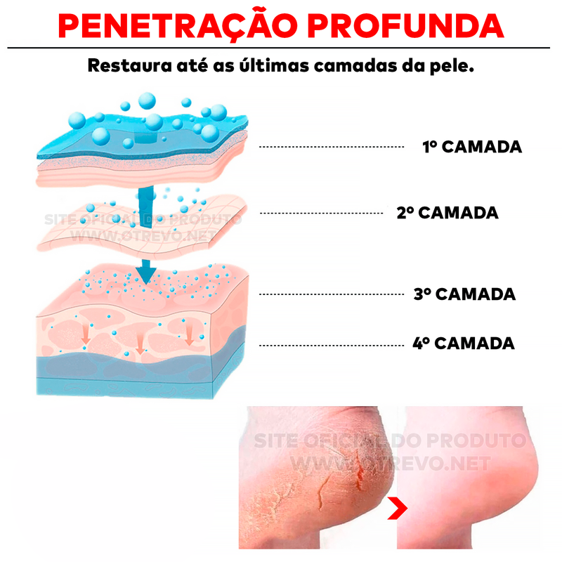 Cera Removedora de Calos e Rachaduras - ®Foot Gold