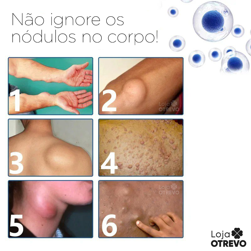 Spray Removedor de Nódulos - Lipomax®