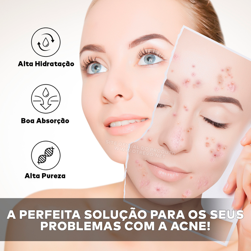 Sérum Removedor de Acne e Poros Dilatados - AcneLanbéna®