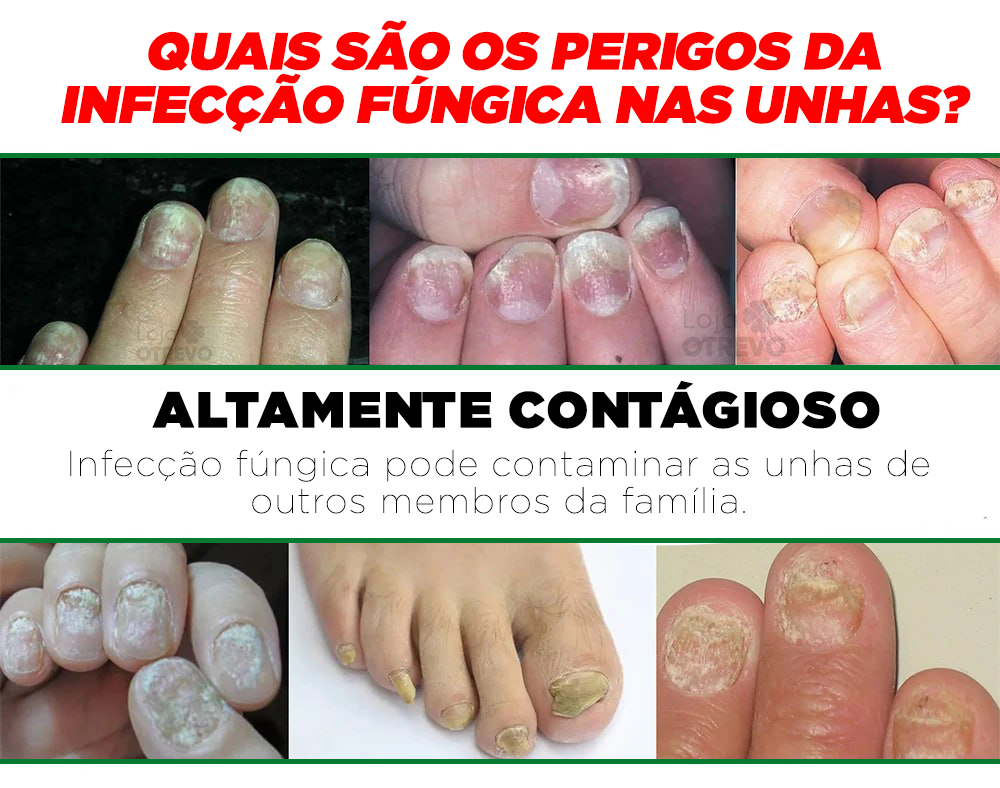 OilNail® - Sérum Reparador Rápido de Unhas (REPARAÇÃO EM 7 DIAS)
