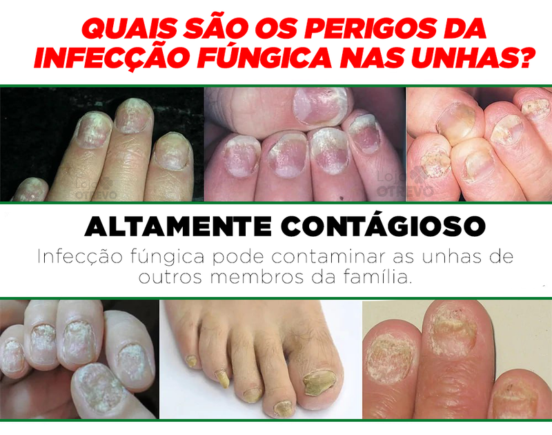 OilNail® - Sérum Reparador Rápido de Unhas (REPARAÇÃO EM 7 DIAS)