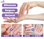 Spray Reparador de Unhas 3 em 1 (Reparador, Restaurador e Fortalecedor de Unhas) MedNail®