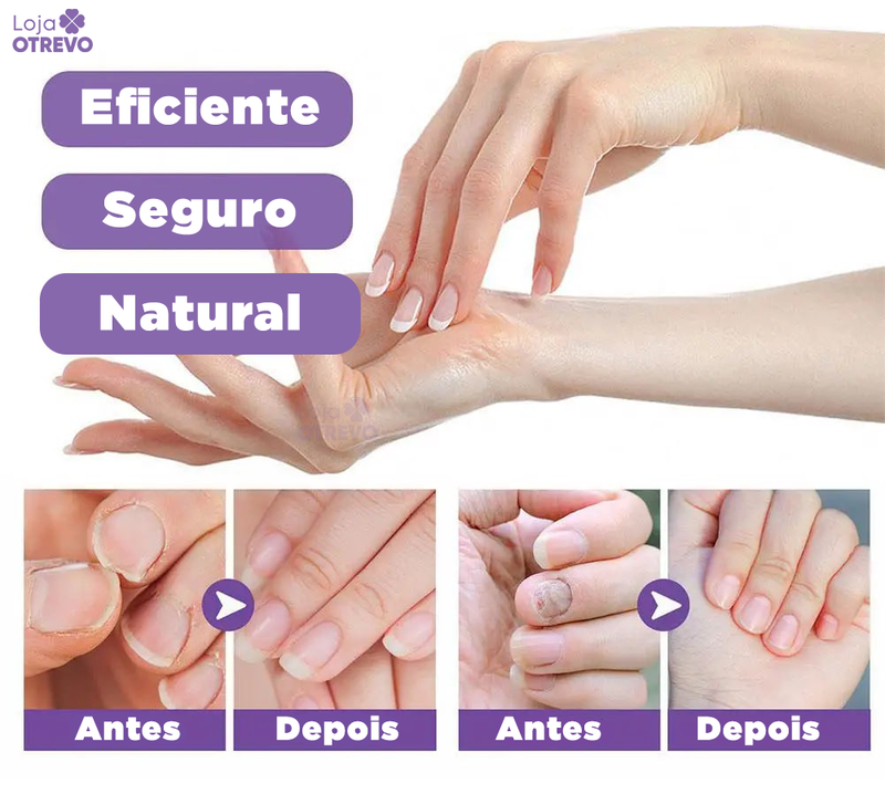 Spray Reparador de Unhas 3 em 1 (Reparador, Restaurador e Fortalecedor de Unhas) MedNail®