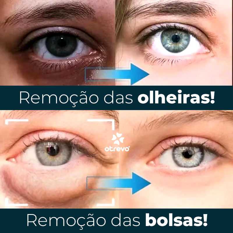 OpenEyes - Creme Reparador Rápido de Olhos (Elimina Rugas, Bolsas e Olheiras)