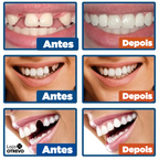 WhiteTeeth® -  Resina Temporária Reparadora de Dentes