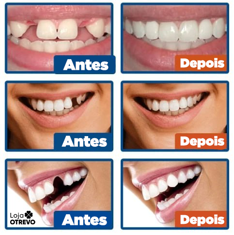 WhiteTeeth® -  Resina Temporária Reparadora de Dentes